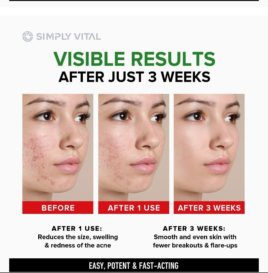 Vitamin E acne & dark spot cream(50g)